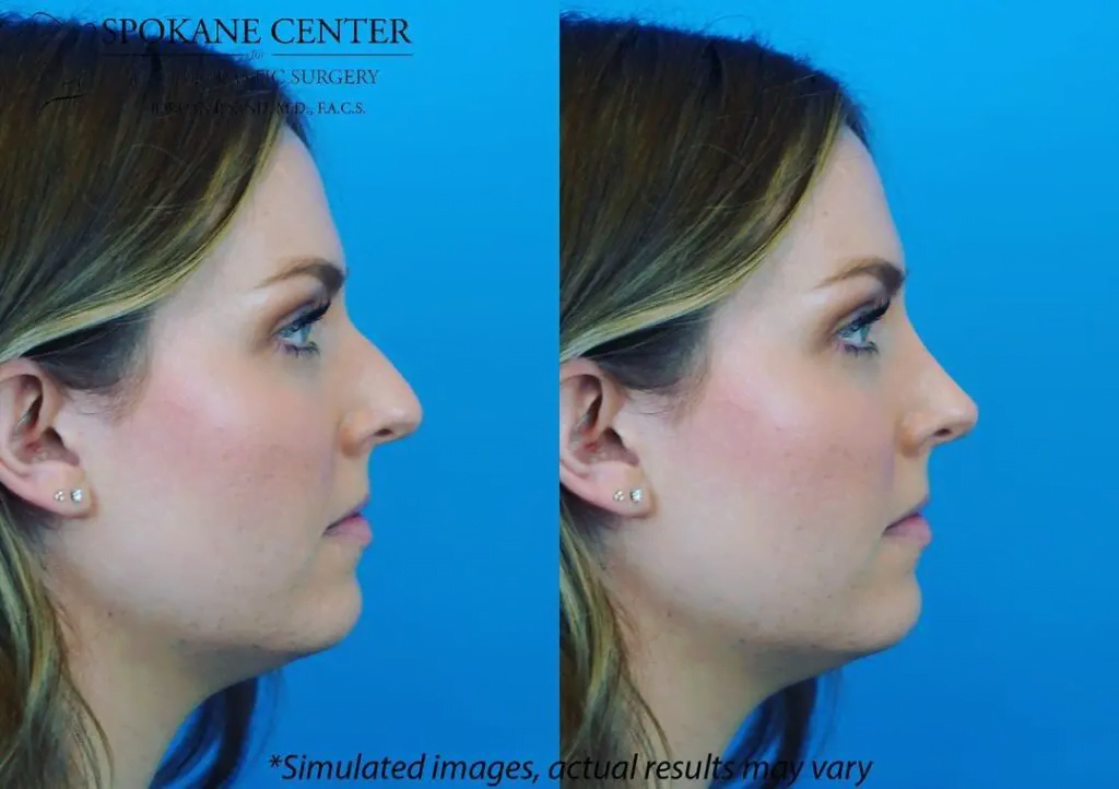 Rhinoplasty 61