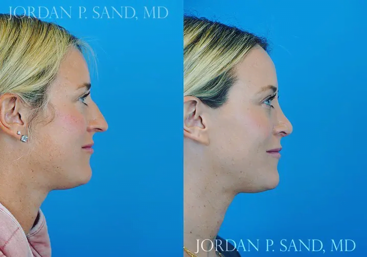 Rhinoplasty 62