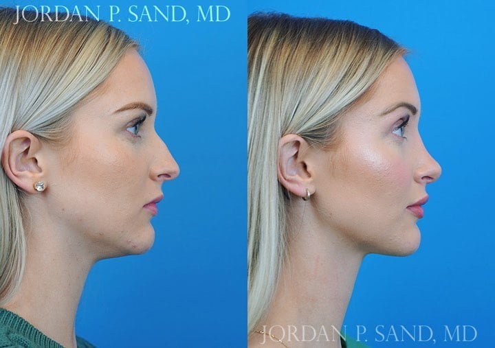 Rhinoplasty 63