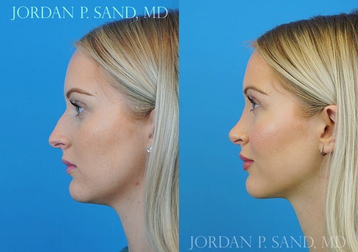 Rhinoplasty 63