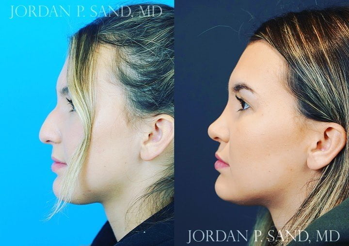 Rhinoplasty 80