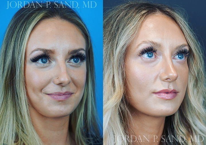 Rhinoplasty 65