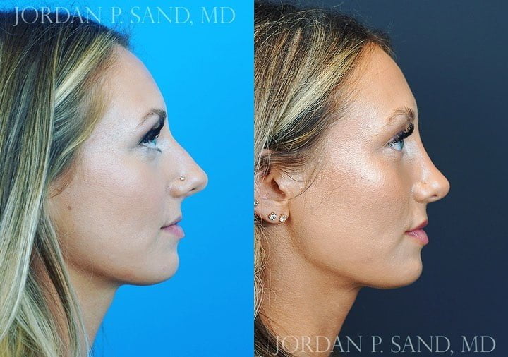 Rhinoplasty 65