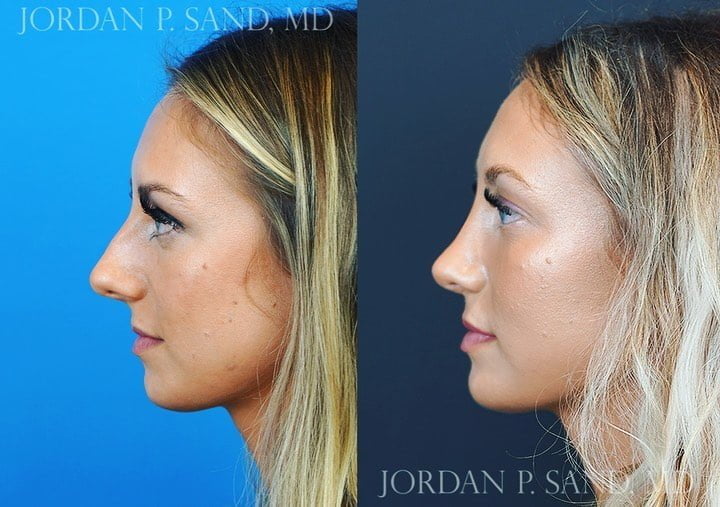 Rhinoplasty 65