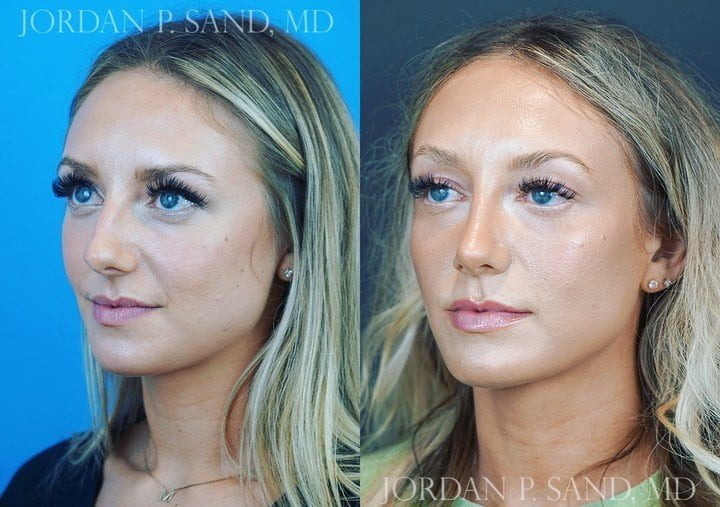 Rhinoplasty 65
