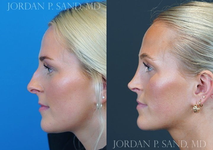 Rhinoplasty 67