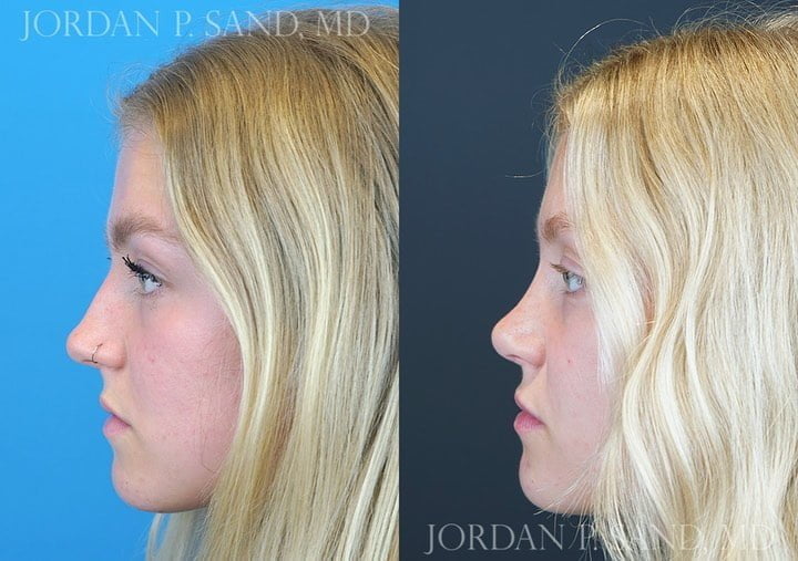 Rhinoplasty 66