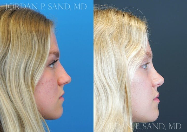 Rhinoplasty 66