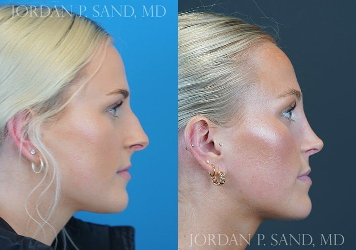 Rhinoplasty 67