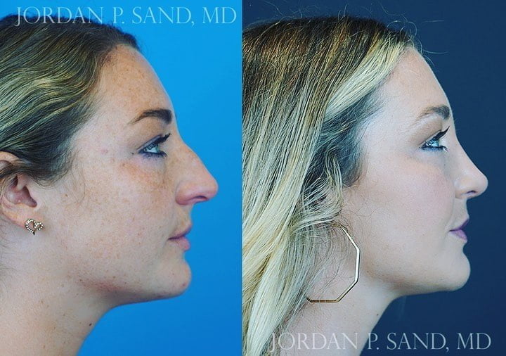 Rhinoplasty 68