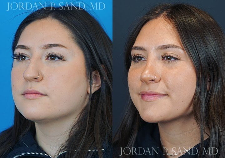Rhinoplasty 69