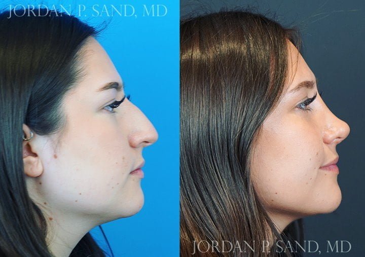 Rhinoplasty 69