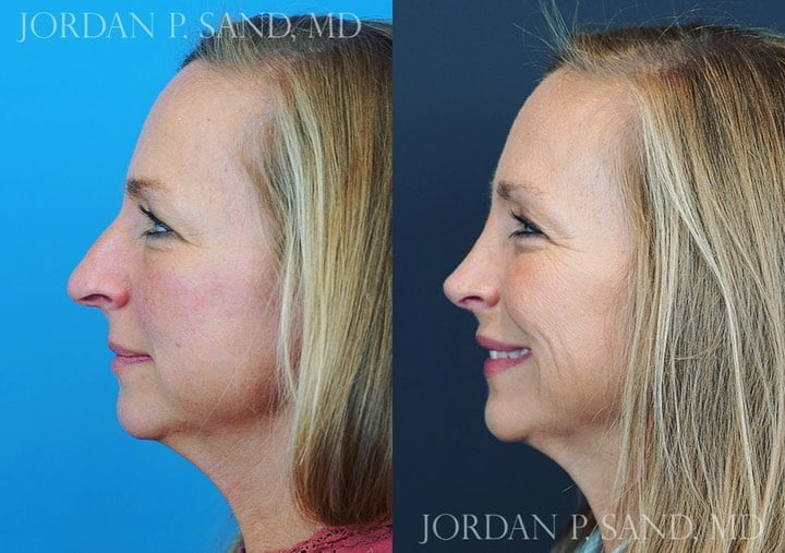 Rhinoplasty 70