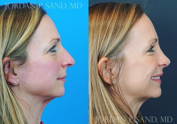 Rhinoplasty 70