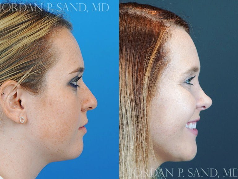 Rhinoplasty 72