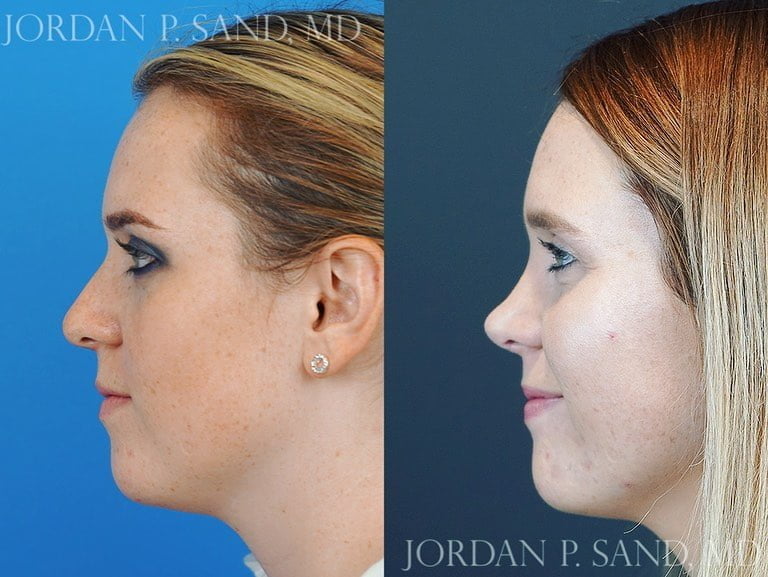 Rhinoplasty 72