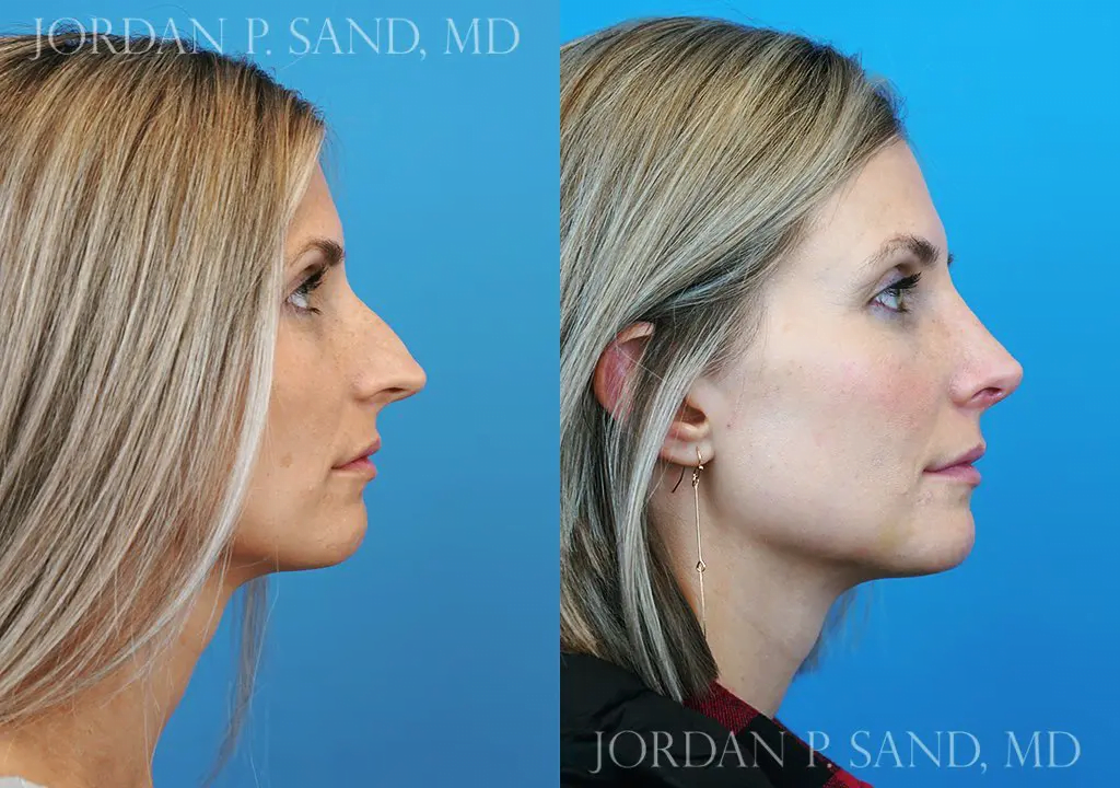 Rhinoplasty 19