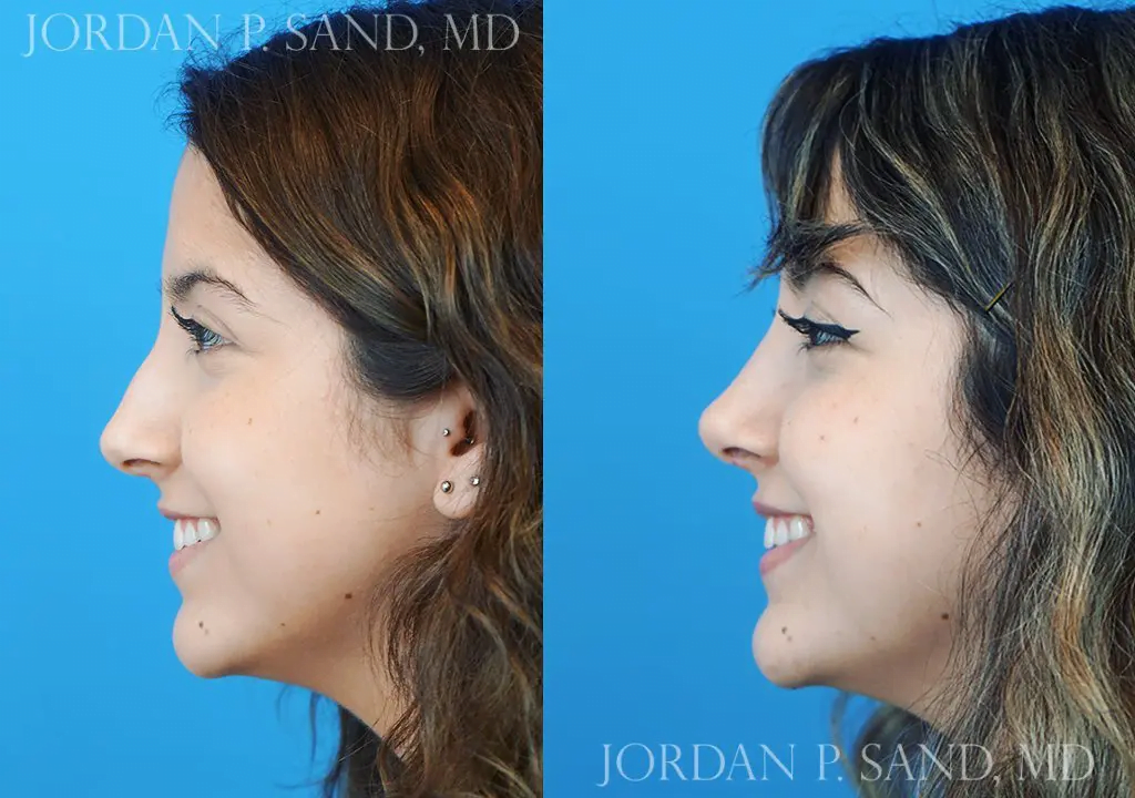 Rhinoplasty 18