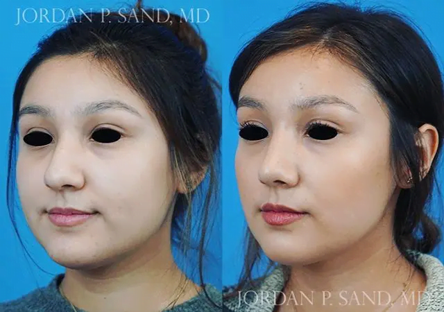 Rhinoplasty 21