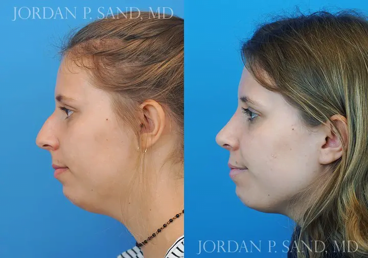 Rhinoplasty 22