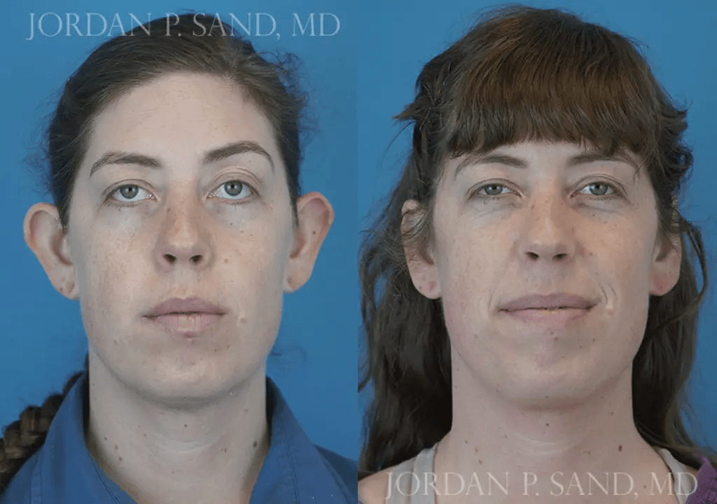 Otoplasty 1