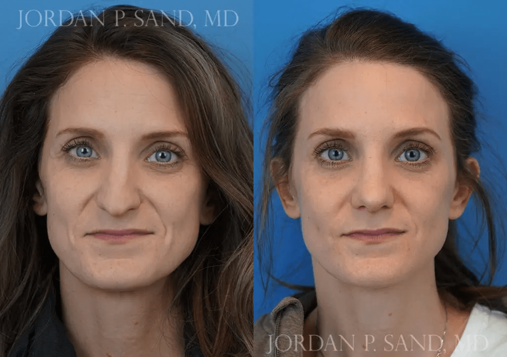 Rhinoplasty 10
