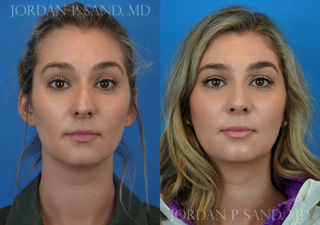Rhinoplasty 11