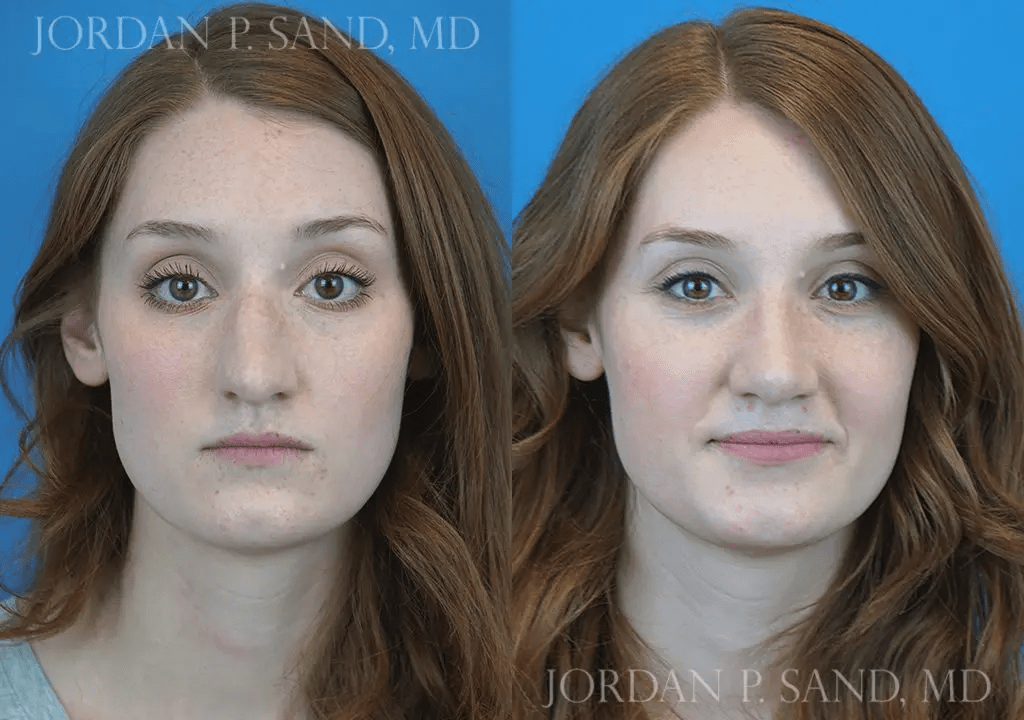 Rhinoplasty 12