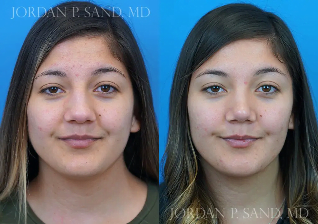 Rhinoplasty 17