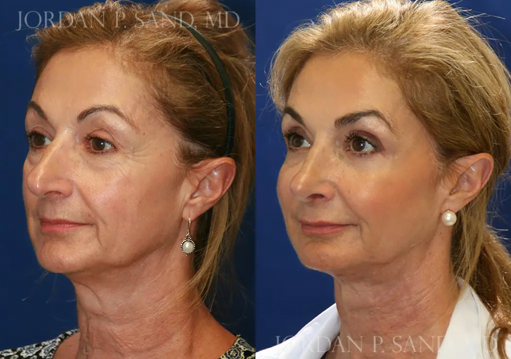 Rhinoplasty 81
