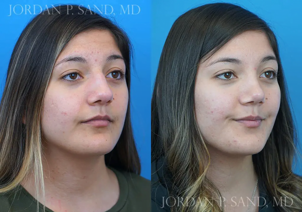 Rhinoplasty 17