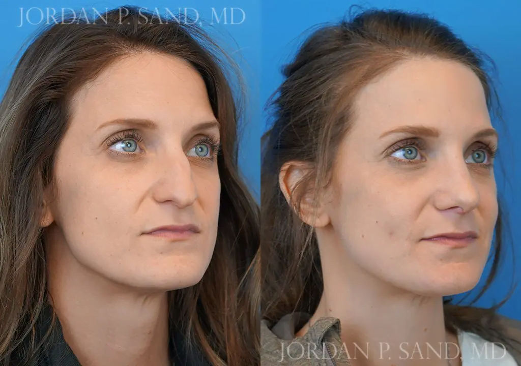 Rhinoplasty 10