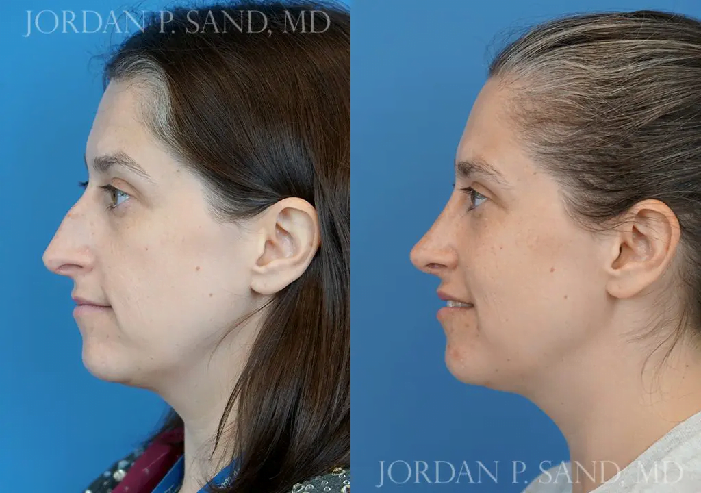 Rhinoplasty 7