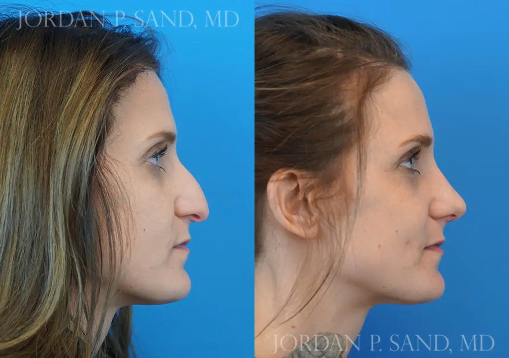 Rhinoplasty 10