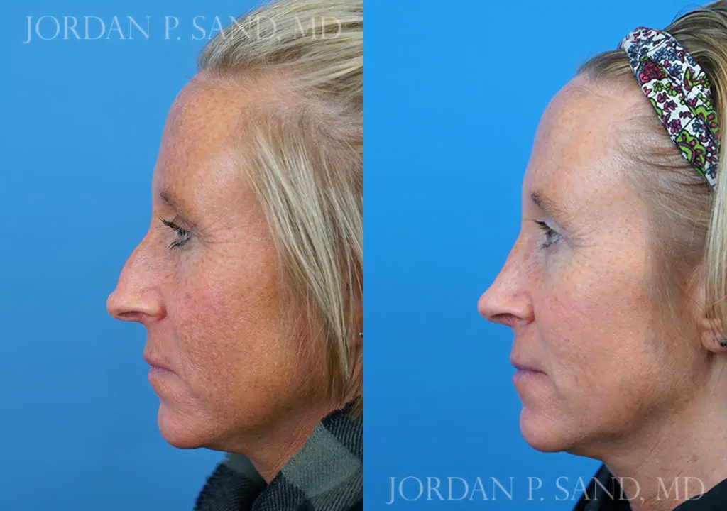 Rhinoplasty 13