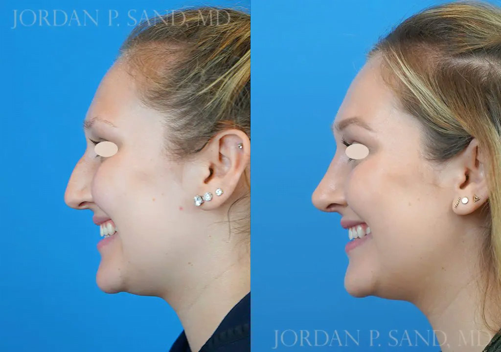 Rhinoplasty 15
