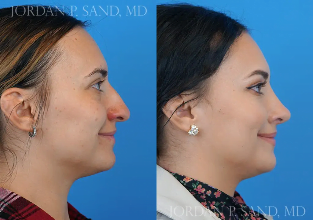 Rhinoplasty 16