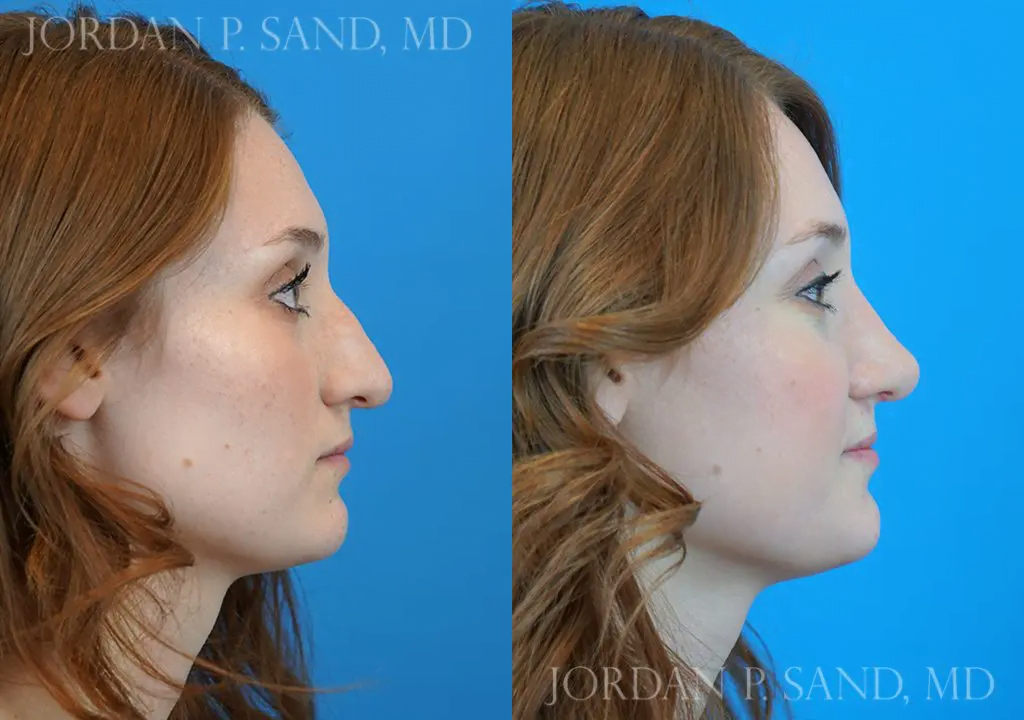 Rhinoplasty 12
