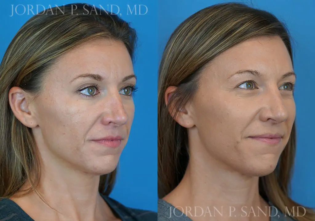 Filler and Botox® 1