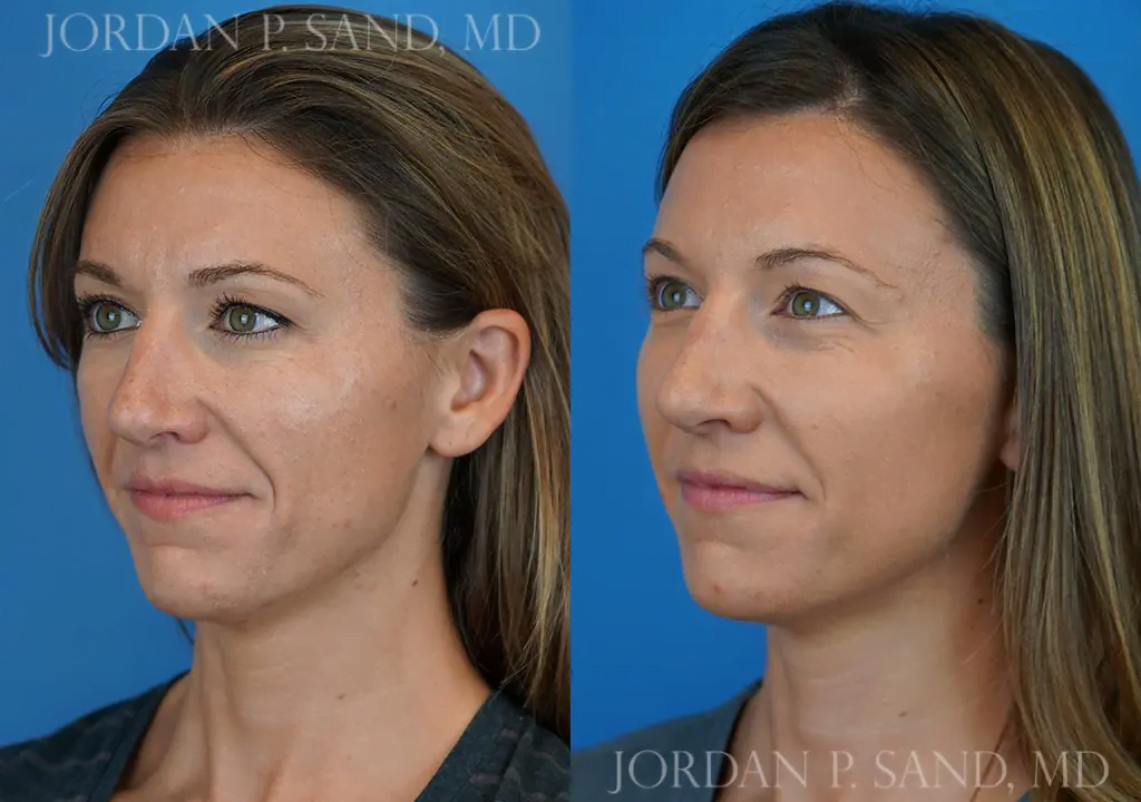 Filler and Botox® 1