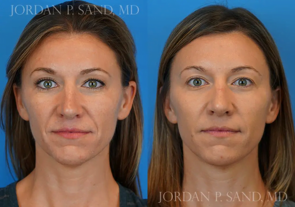 Filler and Botox® 1