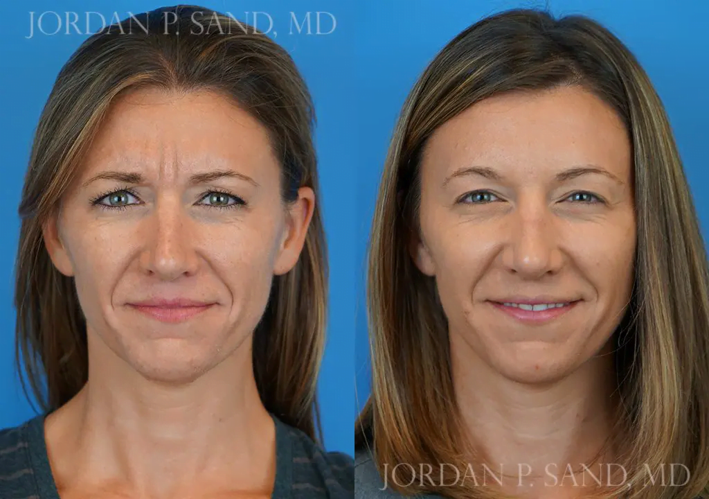 Filler and Botox® 1