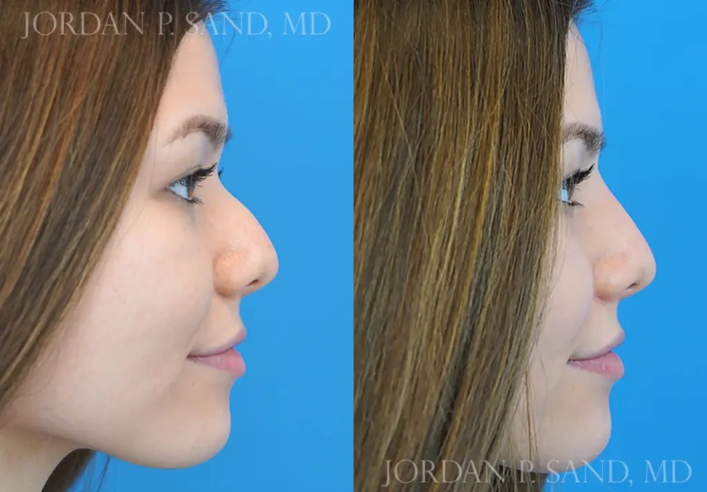 Non-Surgical Rhinoplasty 1