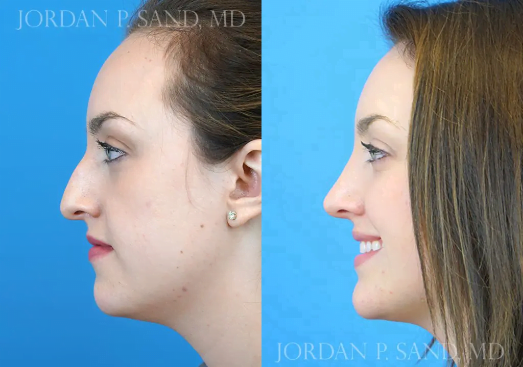 Rhinoplasty 8