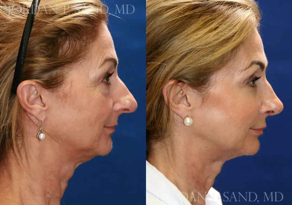 Rhinoplasty 81
