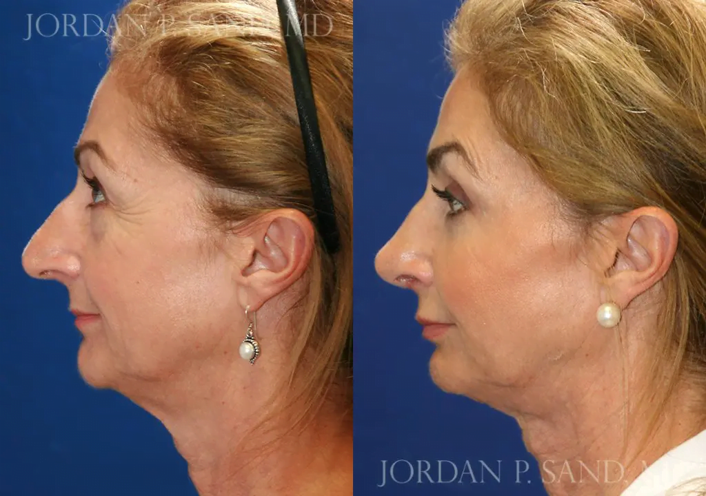 Rhinoplasty 81