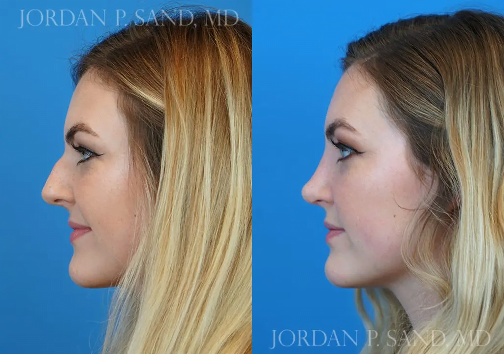 Rhinoplasty 9