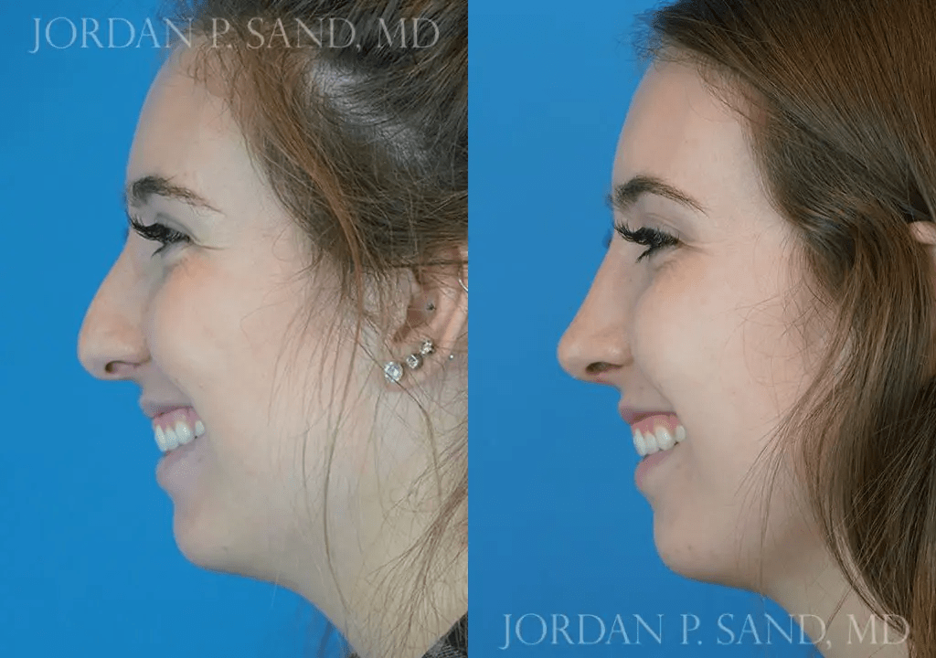 Rhinoplasty 3