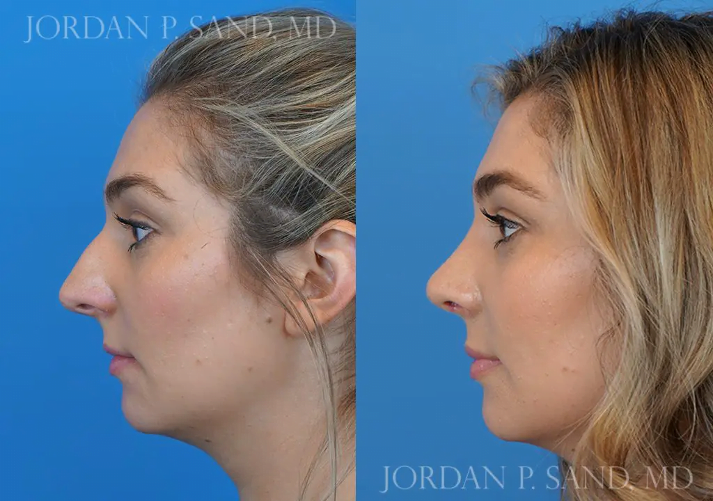 Rhinoplasty 11