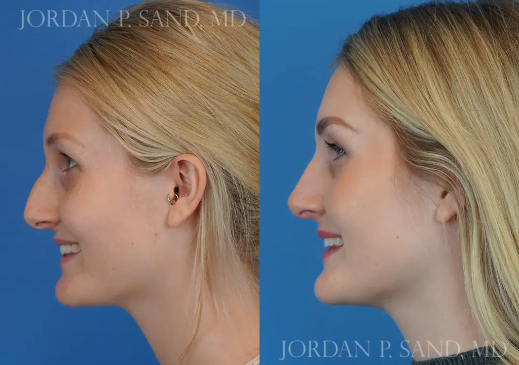 Rhinoplasty 1